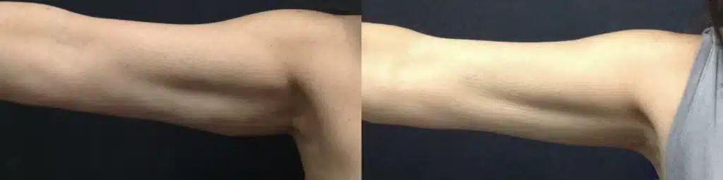 CoolSculpting Elite before and after photo by Monroe MedSpa in Rochester, NY