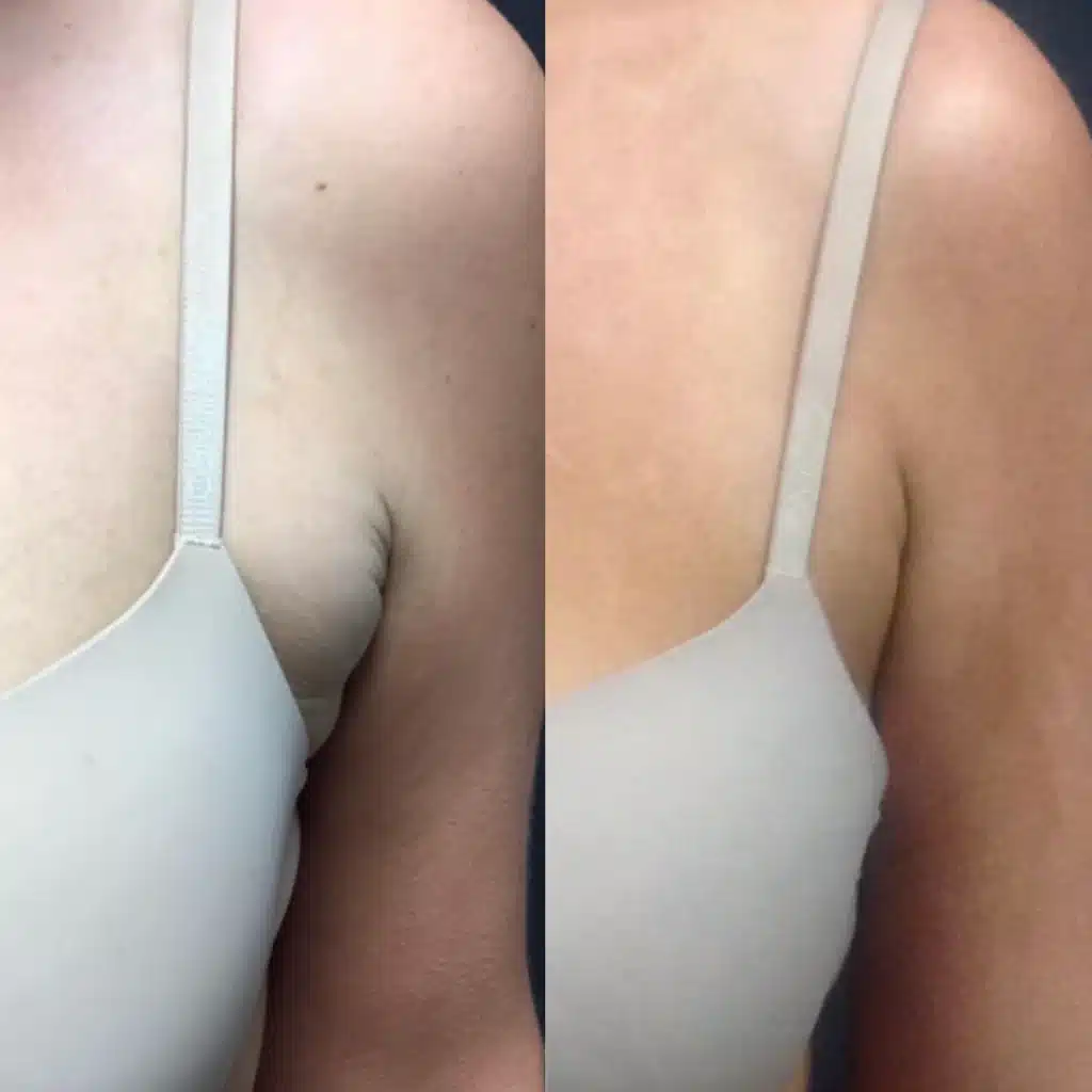 CoolSculpting Elite before and after photo by Monroe MedSpa in Rochester, NY