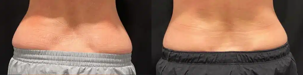 CoolSculpting Elite before and after photo by Monroe MedSpa in Rochester, NY