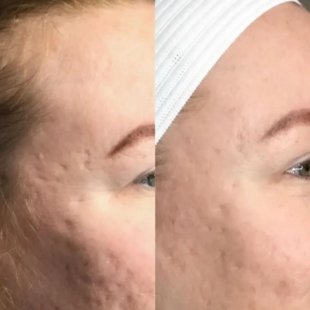 Morpheus8 Microneedling before and after photo by Monroe MedSpa in Rochester, NY