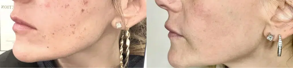 BBL before and after photo by Monroe MedSpa in Rochester, NY