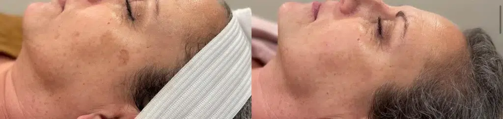 Cynosure Laser (Cuse) before and after photo by Monroe MedSpa in Rochester, NY